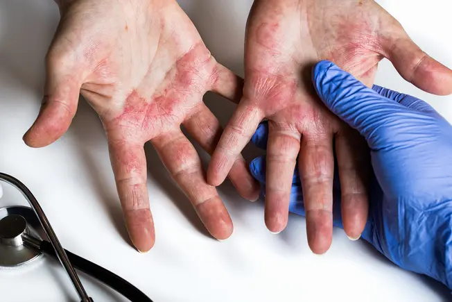 What Is Hand Eczema?